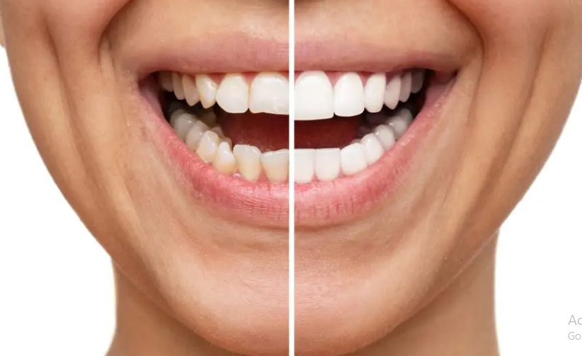 Pop On Veneers Reviews: The Ultimate 2026 Guide